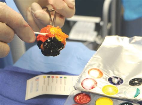 Marginmarker Sterile Ink Kit Tissue Ink Vector Surgical