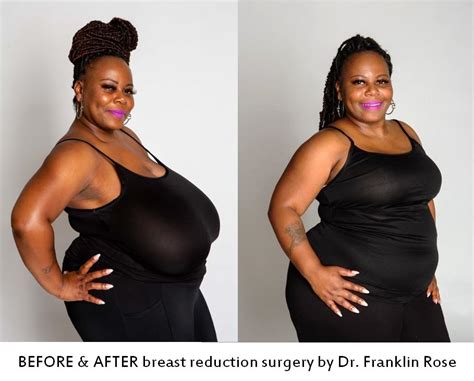 Dr Franklin Rose Reviews Houston Plastic Surgery Blog Biggest