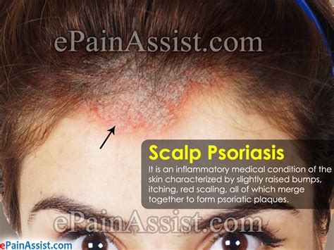 Scalp Psoriasis Treatment Home Remedies Prognosis