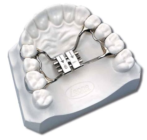 What Is A Rapid Palate Expander In Orthodontics Archwired