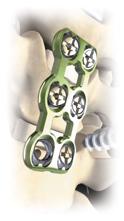 Maxan® Anterior Cervical Plate System Zimvie Spine Solutions
