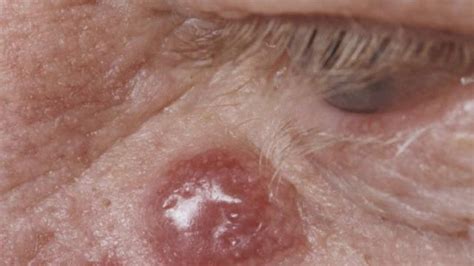 Skin Cancer Rash Itchiness And Symptoms