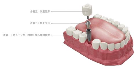 台中人工植牙推薦－法拉｜植得您信賴的人工植牙療程