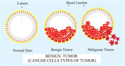 Benign Tumor Is One Which Isashowing Metastasisbdifferentiated And