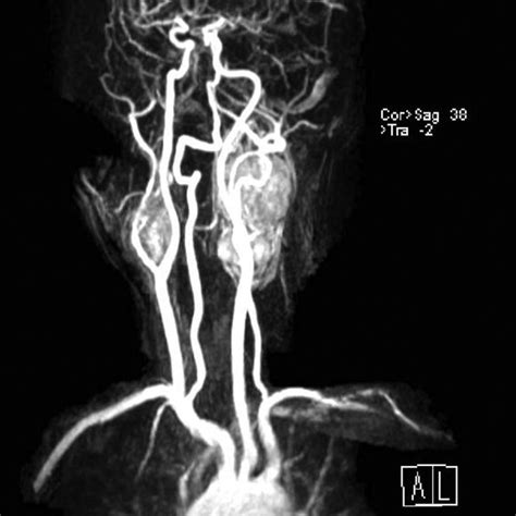 Axial T 1 Weighted MR Image Showing Bilateral Carotid Body Tumors Both