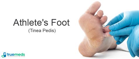 Athlete S Foot Tinea Pedis Causes Symptoms And Diagnosis