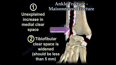 Ankle Fracture Maisonneuve Fracture Everything You Need To Know Dr