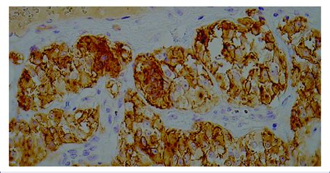 Positive Immunohistochemistry For Cd117 In An Epithelioid Type