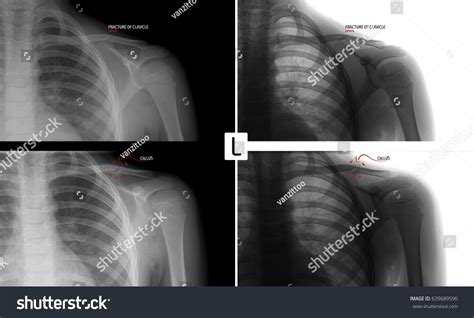 Xray Left Collarbone Fracture Clavicle Child Stock Photo 639689590