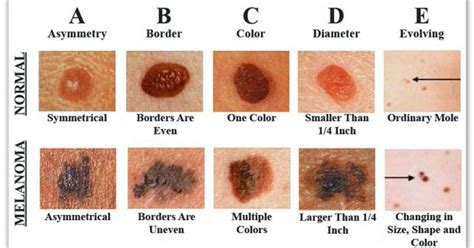 We want things to look at flawless as possible. How To Recognize Skin Cancer - This Could Save Your Life