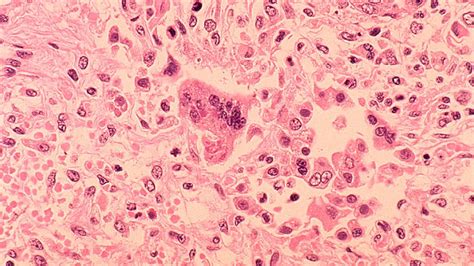 Ohio Measles Outbreak Largest In Usa Since 1996