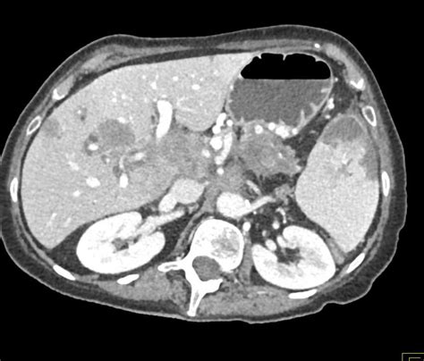 Pancreatic Adenocarcinoma With Liver Metastases And Left Femoral Vein