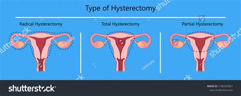 Laparoscopic Hysterectomy Medical Surgical Treat Cervix
