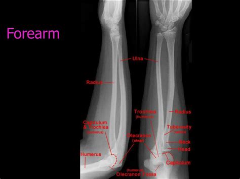 Ppt Normal X Ray Anatomy Powerpoint Presentation Free Download Id