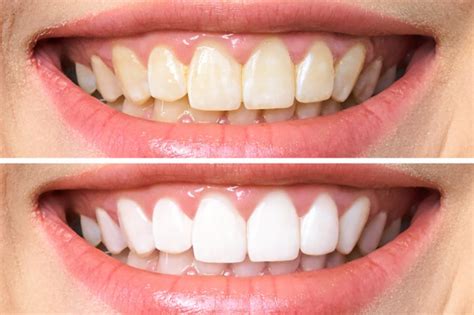 What Is Air Polishing For Teeth And How Does It Work