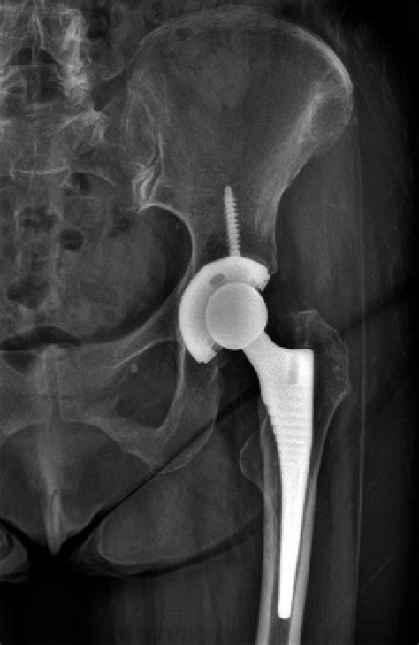 Injury To The Hip Abductors After Total Hip Arthroplasty Treated With