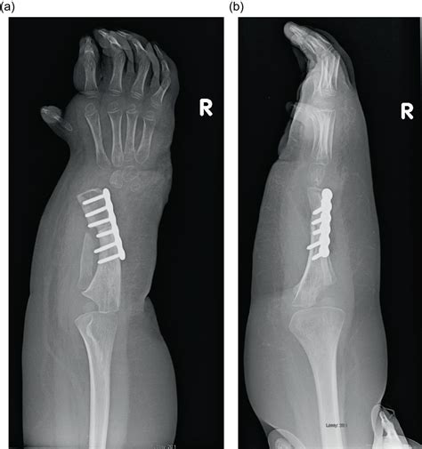 The Paley Ulnarization Of The Carpus With Ulnar Shortening Osteotomy