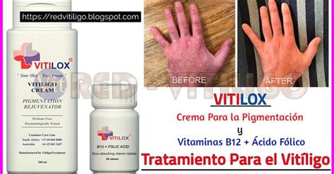 Vitilox Tratamiento Para El Vitiligo