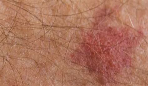 Bed Bug Bite Scar How To Get Rid Of It The Pestpedia