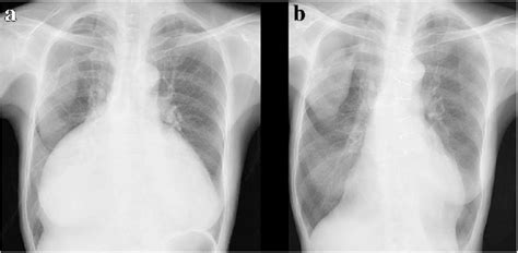 A Chest X Ray At Preoperative Examination Showed Severe Enlargement Of