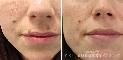 Mole Removal In Leeds From £345 Skin Surgery Clinic Bradford