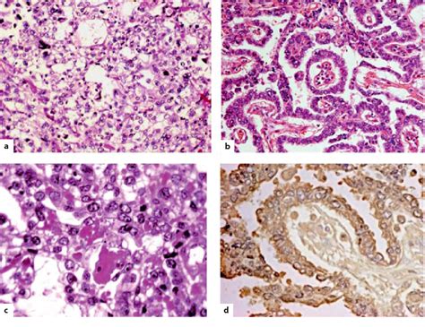 Pathology Of Intracranial Germ Cell Tumors Semantic Scholar