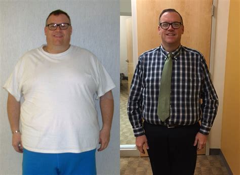 Gastric Bypass Before And After