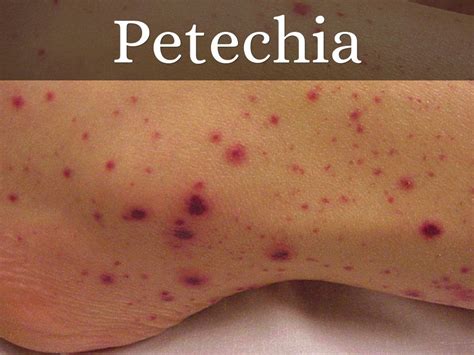 Ecchymosis Vs Petechiae