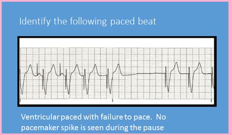 Telemetry Technician Course Pacemaker Practice Class 10