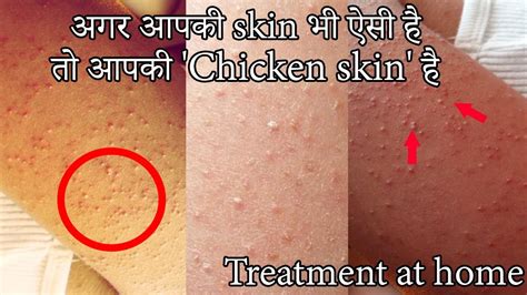 Chicken Skin Treatment Alarge Body Solution In Hindikatha Brana