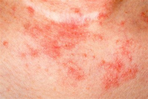 Eczema Facts Things You Need To Know Readers Digest