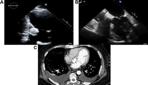 Caseous Calcification Of The Mitral Annulus Presenting With Symptomatic