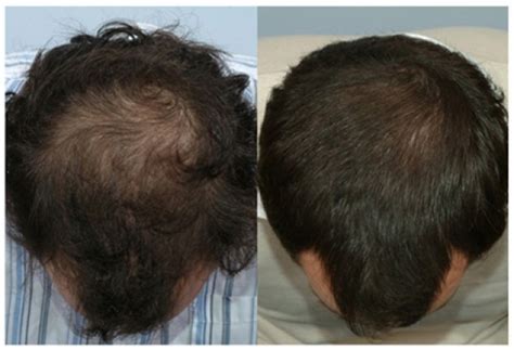 Finasteride is contraindicated in women when they are or may potentially be pregnant, because it may cause abnormalities of the. Finasteride use on the crown - before and after results
