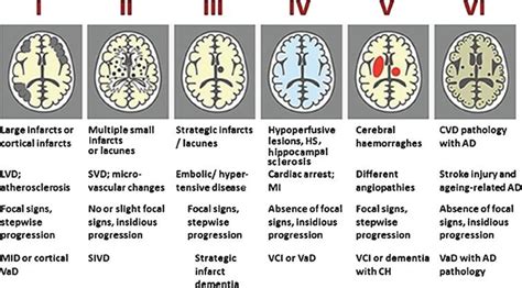 Update On Vascular Cognitive Impairment Associated With Subcortical