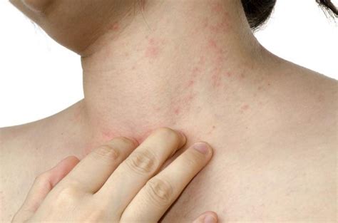 Causes Of Itchy Red Bumps On The Neck Livestrongcom