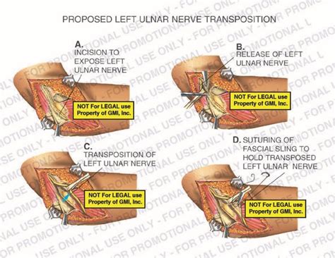Proposed Left Ulnar Nerve Transposition 97148b20b Generic Medical
