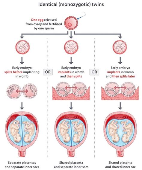 Identical Twins Monozygotic Neet Pg Medicaltalknet The Best