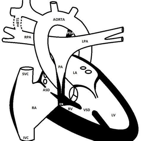 Schematic Representation Of Tricuspid Valve Atresia After The