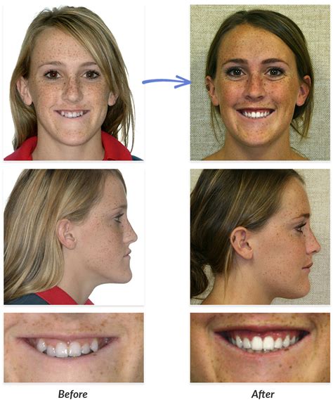 Before After Braces Photos Delurgio Orthodontics Delurgio