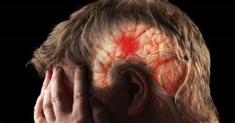 Causas S Ntomas Y Tratamiento Para Controlar Una Hemorragia Cerebral