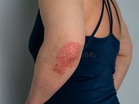 Psoriasis On Elbow Isolated Closeup Of Rash And Scaling On The
