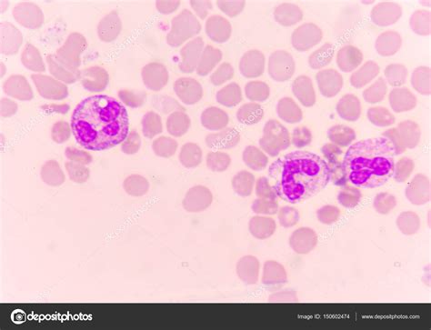 Neutrófilo Anormal No Esfregaço De Sangue — Fotografias De Stock