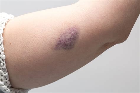 What The Color Of Your Bruise Is Trying To Tell You The Healthy
