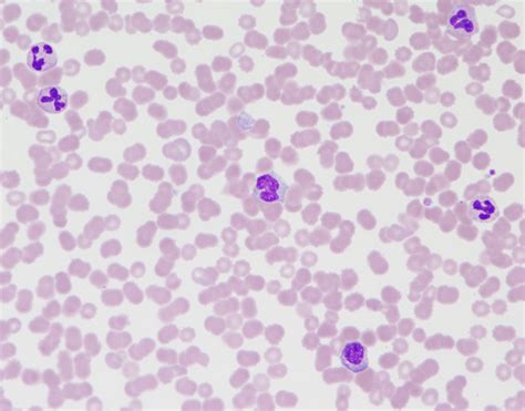 Neutrophilia With Left Shift Monocytosis And Low Platelets With
