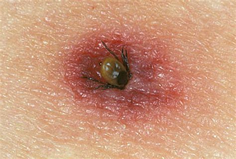 Tick Bites On Humans Images Symptoms Causes Treatment Hubpages