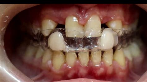 Temporary Teeth With Essix Appliance Replacing Congenital Missed