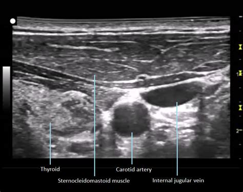 Neck Anatomy Ultrasound