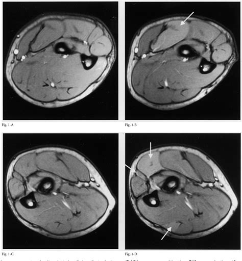 Figure 1 From A Case Report Bilateral Chronic Exertional Compartment