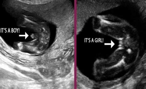 Gender Girl 20 Week Ultrasound 4d Cenfesse