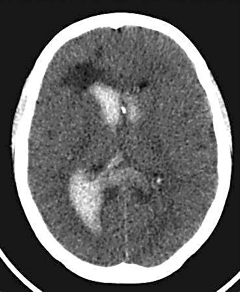 Figure 1refractory High Intracranial Pressure Following